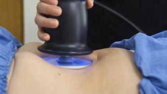 脂肪瘤高清视频高清视频免费下载视频素材视频素材