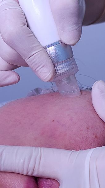 脂肪瘤视频素材免费下载高清视频视频素材
