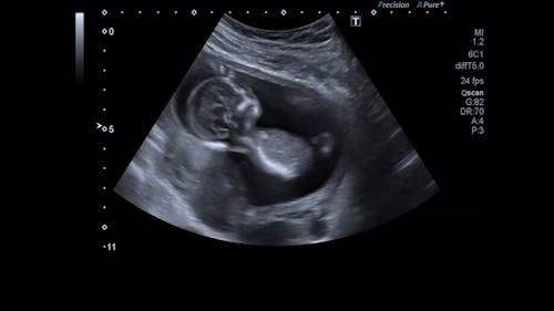 Ultrasound Of A Baby