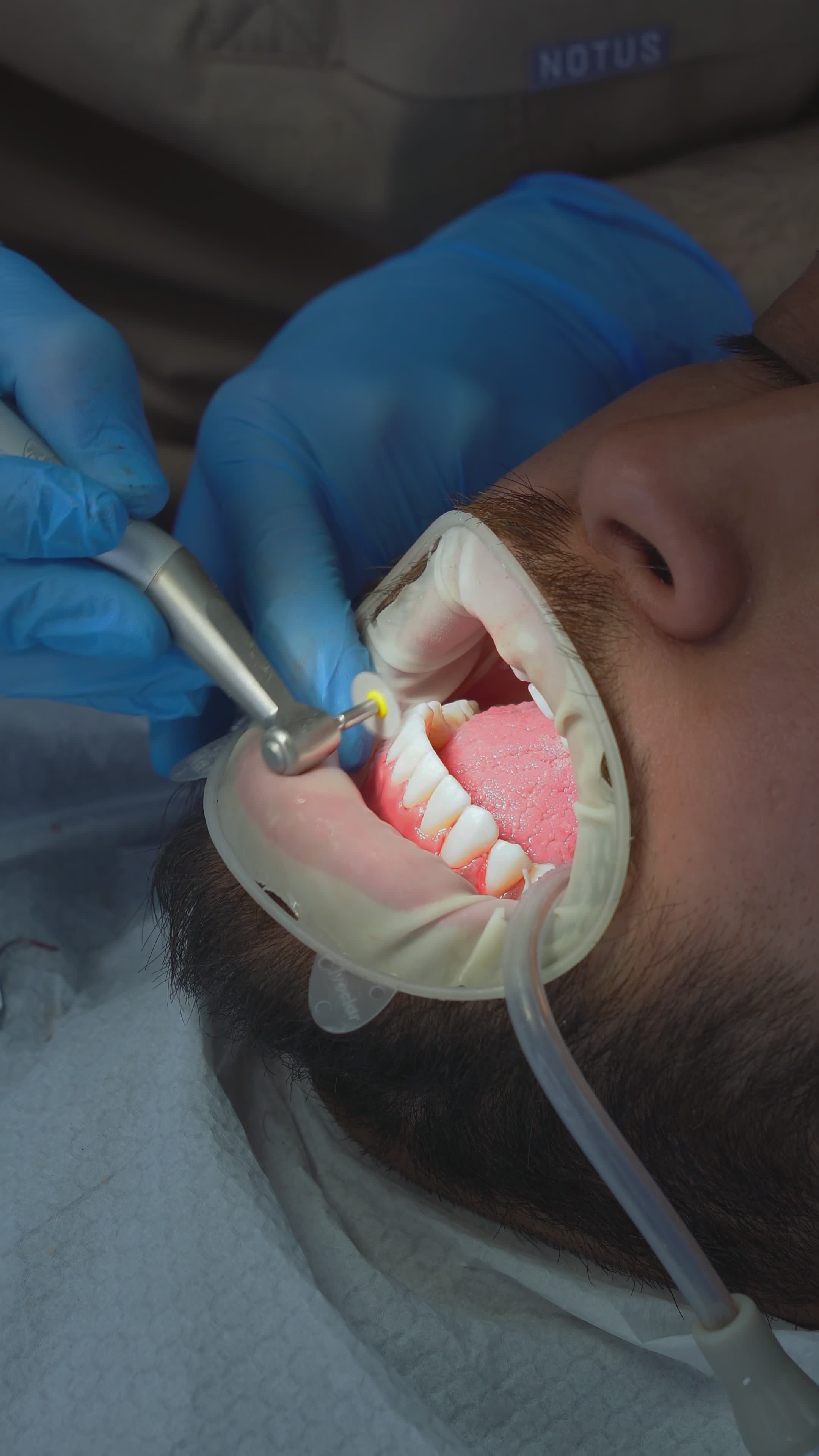 Professional Dental Cleaning Procedure in Clinic Free Stock Video ...