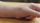 wound