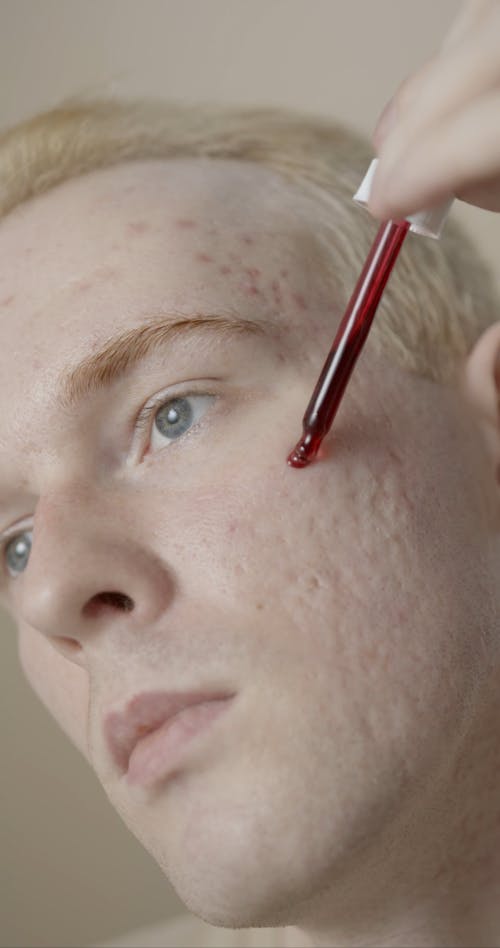 A Man Applying Liquid Medicine On His Face