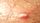 pimples