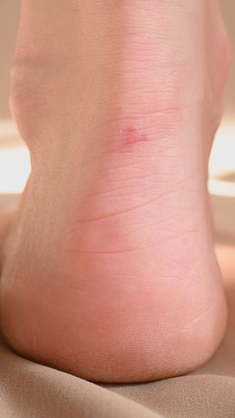 水肿视频素材