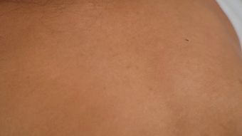 起疹子视频素材