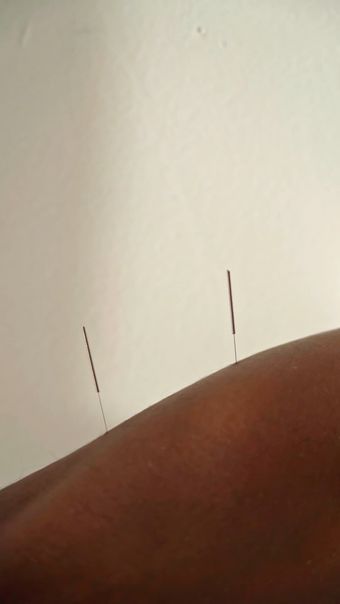 督脉任脉灸视频素材