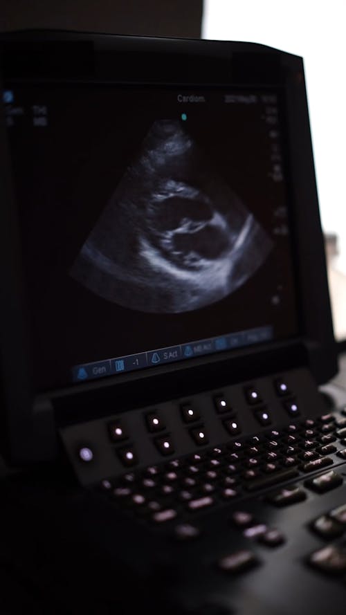 1,327 Echocardiogram Stock Video Footage - 4K and HD Video Clips